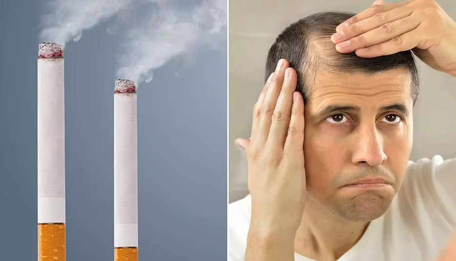 Smoking increases hair loss.