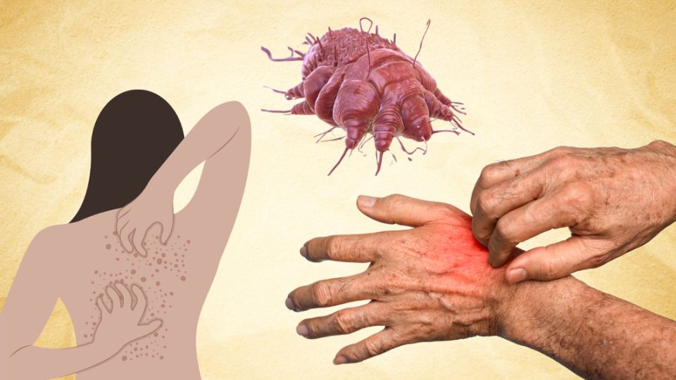 scabies-0